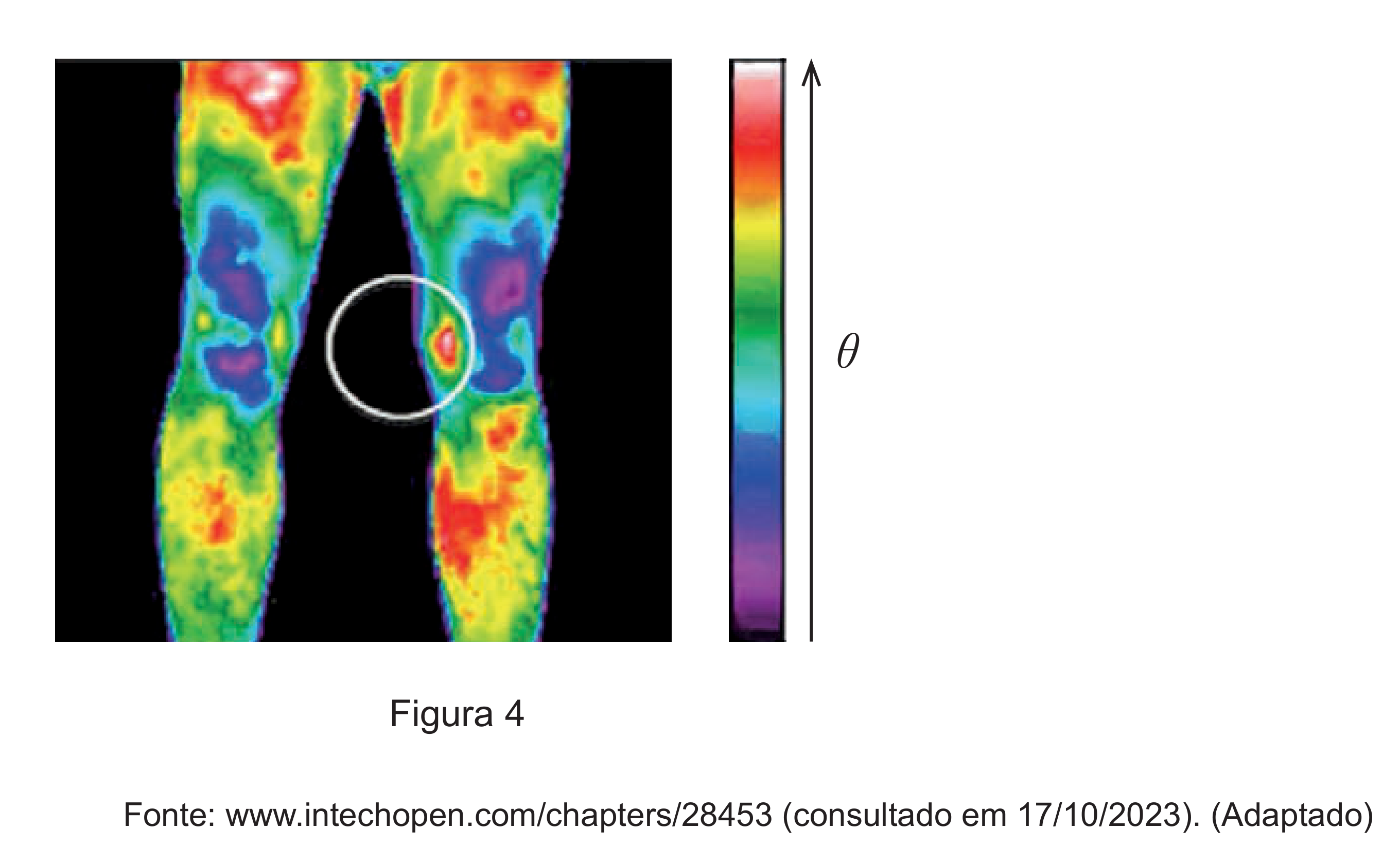 Figura 4: termografia das duas pernas de um atleta, com uma zona de temperatura mais elevada assinalada com um círculo na região medial do joelho